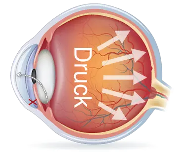 Glaukom Auge - Glaucoom - Augenärzte Gerl & Kollegen