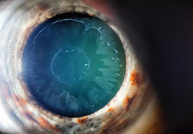 Pseudoexfoliationsglaukom - PEX