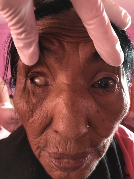 csm UNADJUSTEDNONRAW thumb 2060a 85715964d9 - Oogartsen in Nepal - Augenärzte Gerl & Kollegen