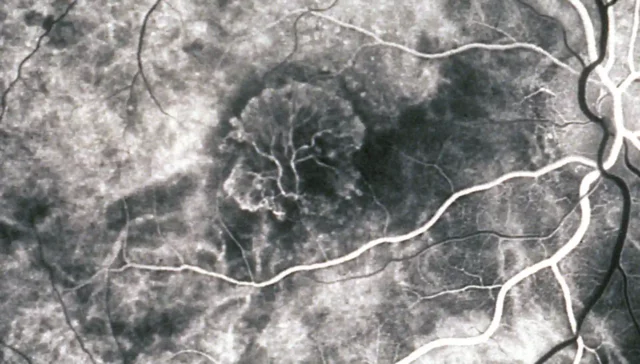 Visualisatie van de lekkende bloedvaten met een fluorescerend contrastmiddel