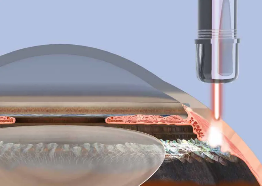 kontrollierte Zyklophotokoagulation (CoCo)