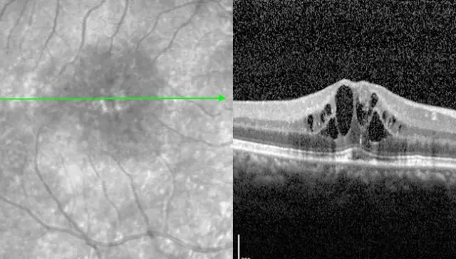 Diabetisches Makulaödem - DMÖ