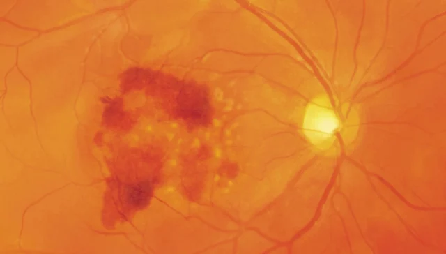 Bloedingen in het gebied van de macula bij natte LMD