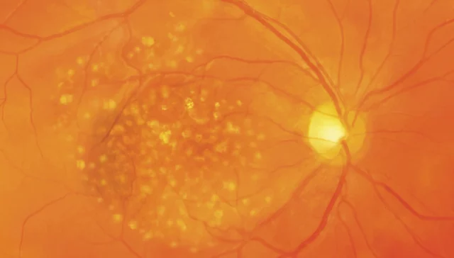 In het gebied van de macula zie je veel gele aanslag (drusen). Dit is het vroege stadium van droge maculadegeneratie.