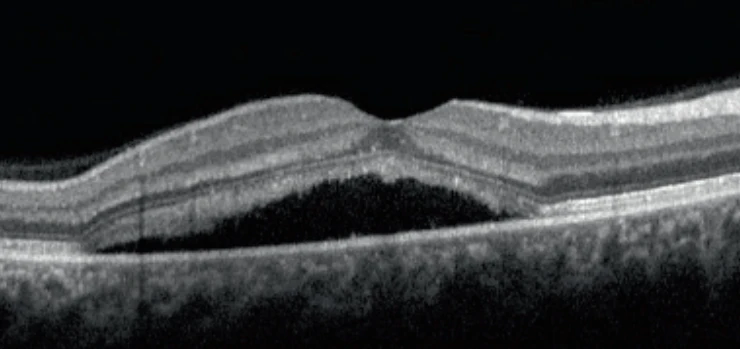 Retinopathia centralis serosa