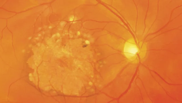 Zeer uitgesproken laat stadium van droge AMD