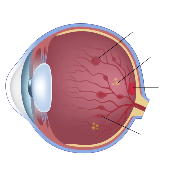 nicht proliferative Form - Diabetes en het oog - Augenärzte Gerl & Kollegen