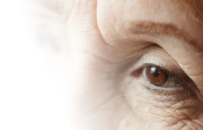 Altersveraenderungen am Lid - Leeftijd gerelateerd - Augenärzte Gerl & Kollegen