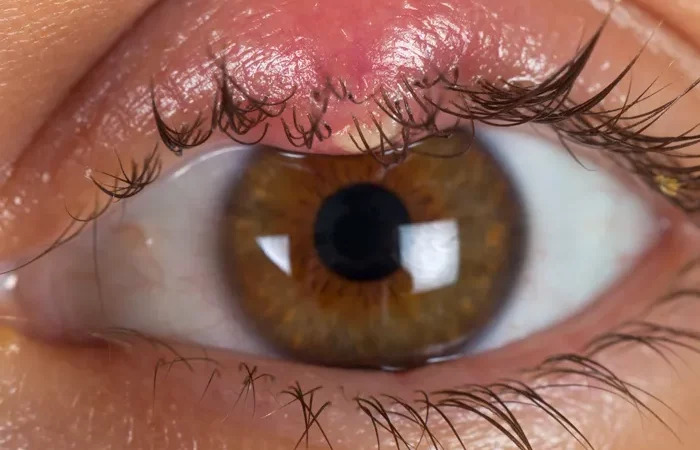 Gerstenkorn (Hordeolum)