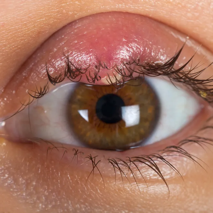 Gerstenkorn (Hordeolum)