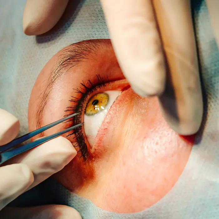 Intravitreale Injektionen (IVOM)