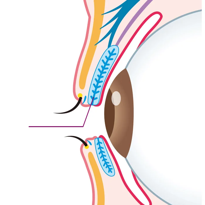 Meibomdruesen - Meibomitis - Augenärzte Gerl & Kollegen