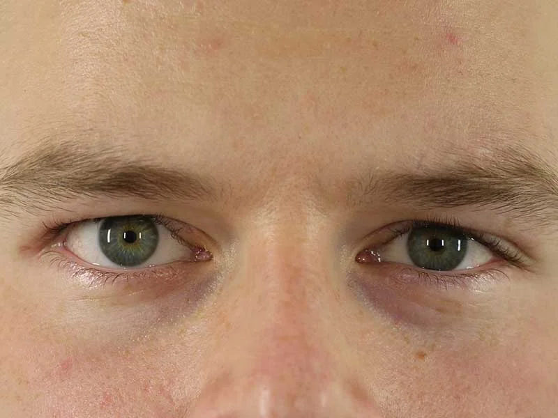 Ptosis am Oberlid nachher