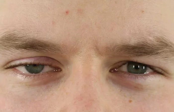 Ptosis am Oberlid vorher