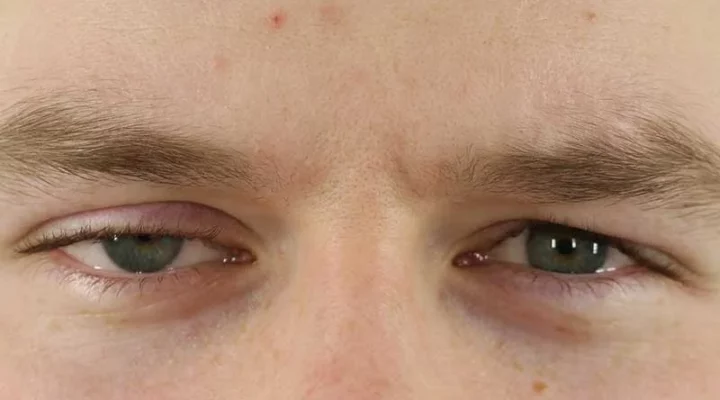 Ptosis am Oberlid vorher