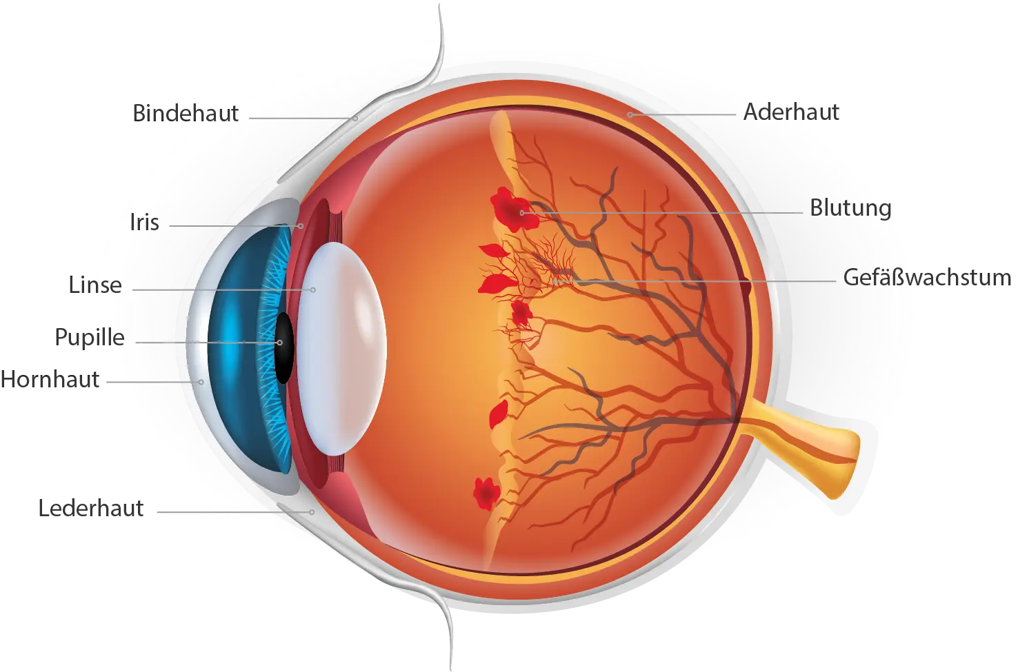 Retinopathia praematurorum