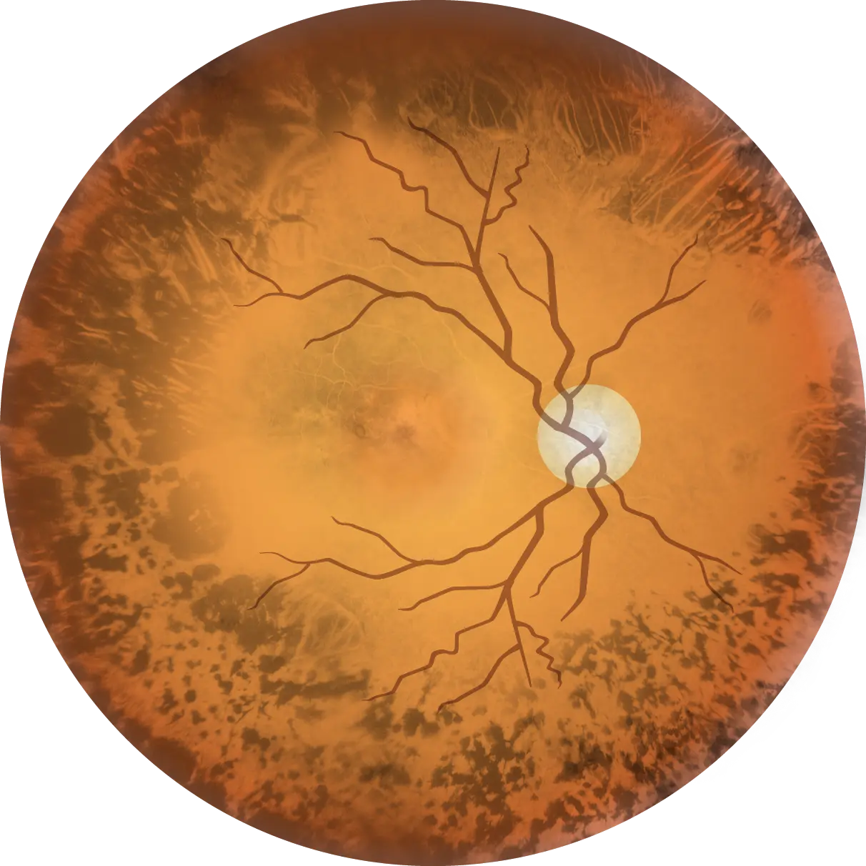 Retinopathia pigmentosa