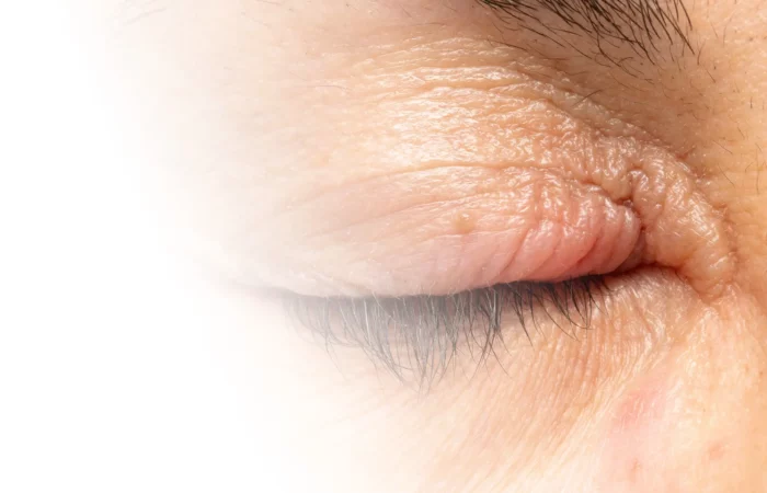 Tumore – Schwellungen am Auge