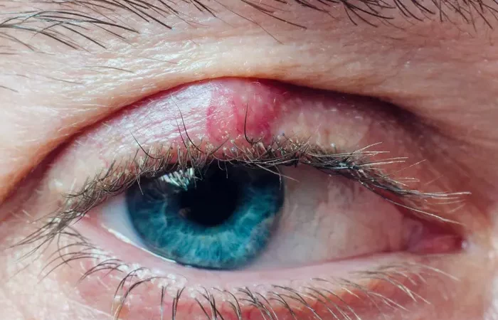 Chalazion (Hagelkorn)