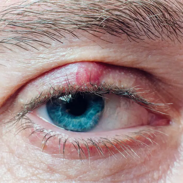 Chalazion (Hagelkorn)