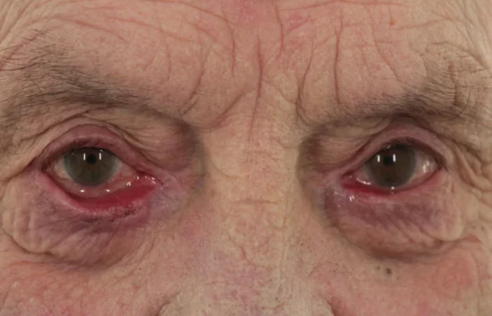 Auswärtskehrung des Lides (Ektropium) © Augenärzte Gerl & Kollegen