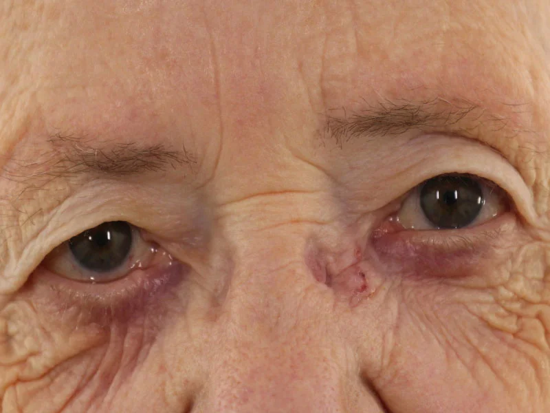 Auswärtskehrung des Lides (Ektropium) © Augenärzte Gerl & Kollegen