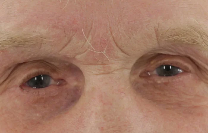 Entropium post © Augenärzte Gerl & Kollegen