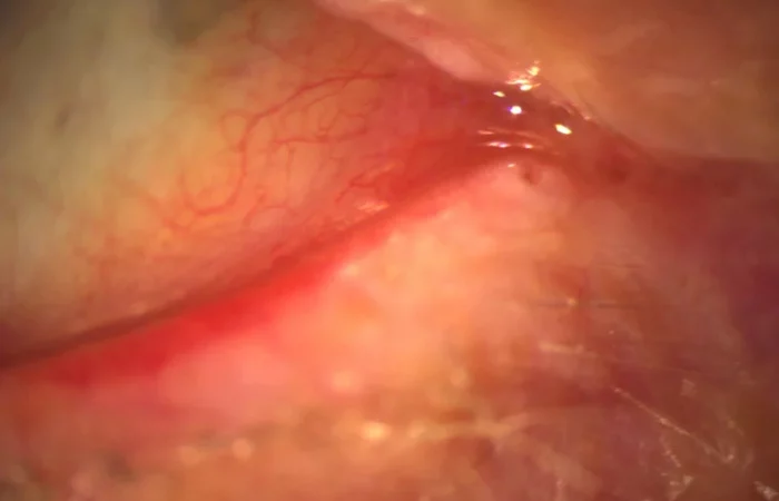 Eversio puncti lacrimalis