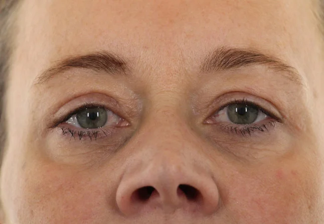 Dermatochalasis_post