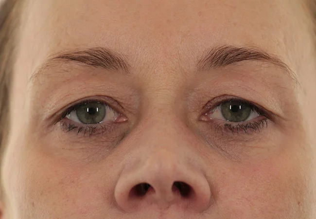 Dermatochalasis_prae