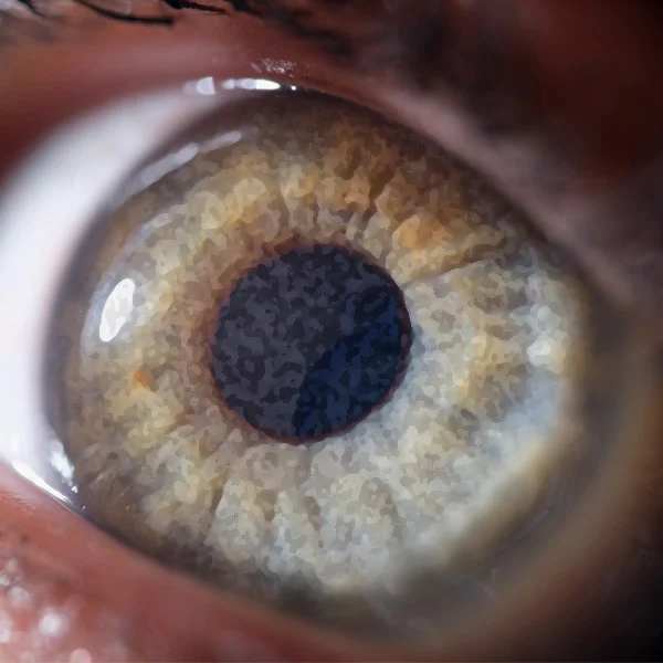 Unklare Hornhaut mit Dystrophie