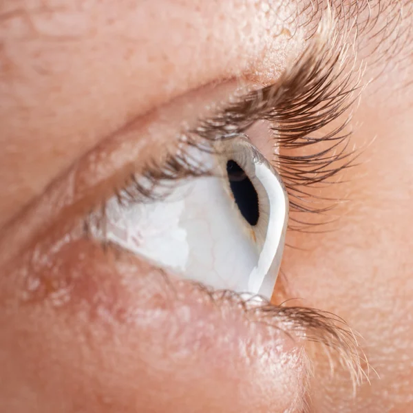 Patient mit Keratokonus