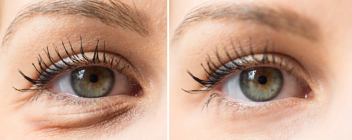 eye bags before after cosmetic treatment - Weefselverslapping boven- en onderooglid - Augenärzte Gerl & Kollegen