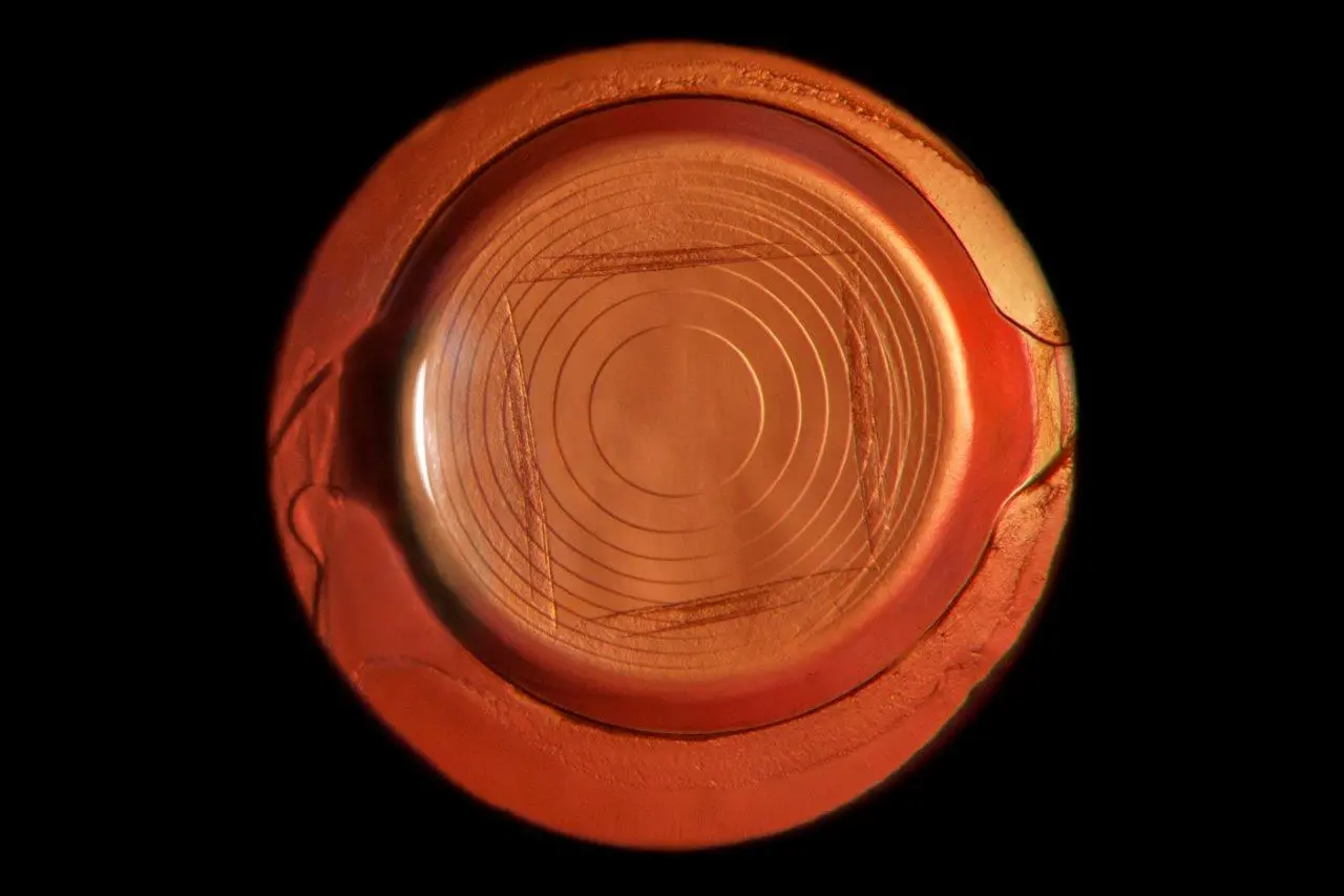 Behandeling van nastaar YAG-lasercapsulotomie